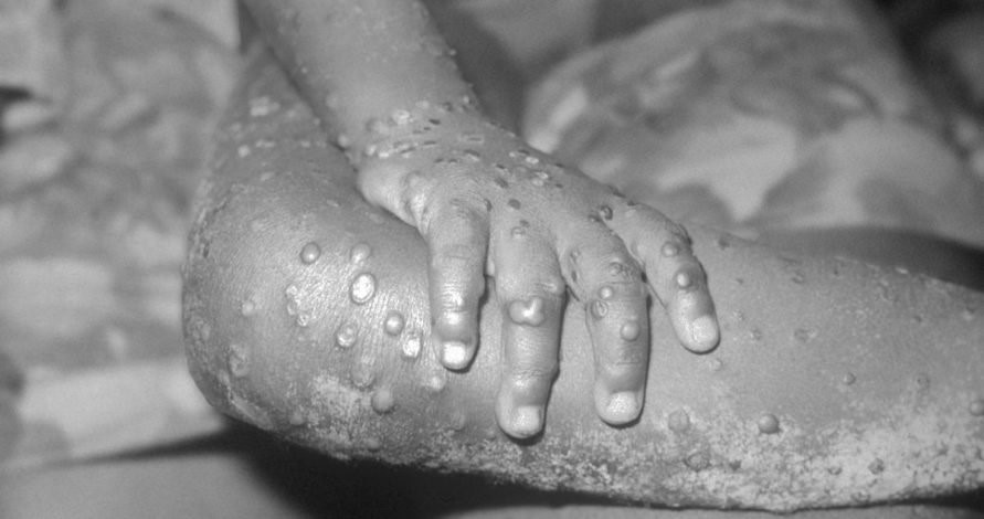 Monkey pox – The Nation