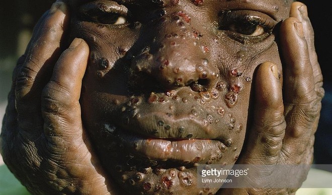 Monkeypox spreads to Kano