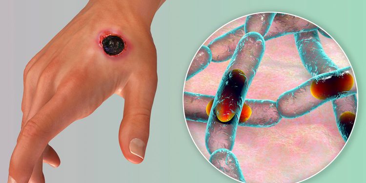 Anthrax is deadly, avoid ponmo, bushmeat – Punch