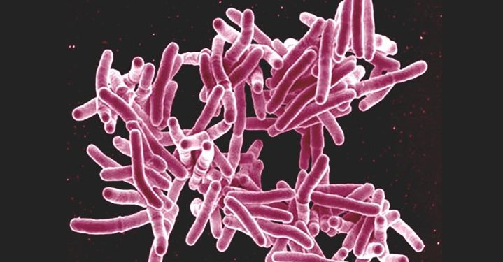 World TB testing: Plateau records over 2,000 TB cases in six months