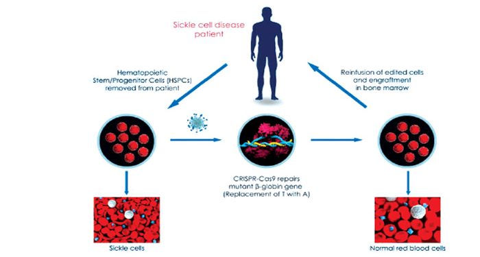 Rising hope for sickle cell carriers over gene editing therapy