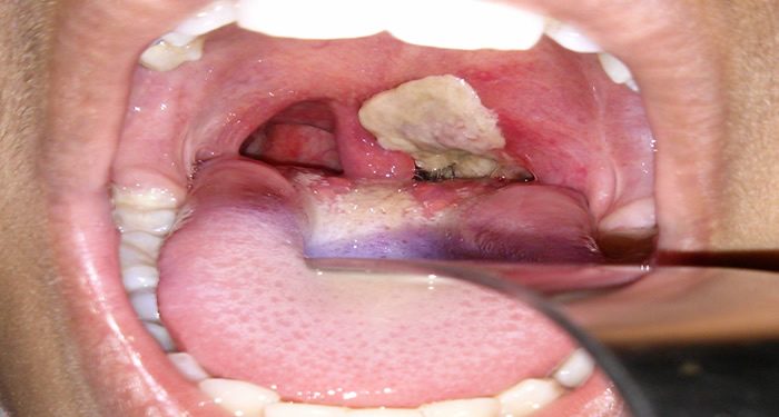 Diphtheria outbreak: Death toll rises to 520 in Kano