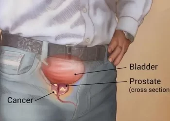 Prostate cancer’s black men number one killer – Experts