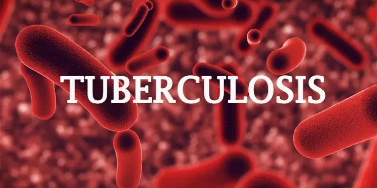 300 die of tuberculosis in Ogun State