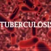 300 die of tuberculosis in Ogun State