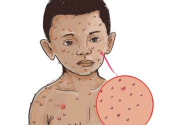 Adamawa shuts schools over measles outbreak