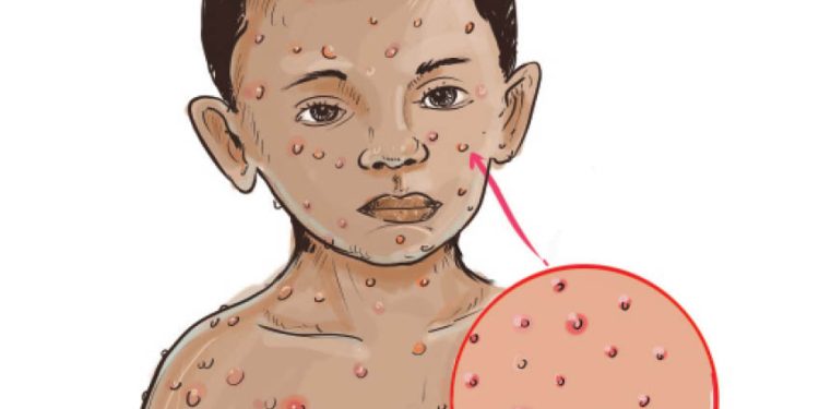 Adamawa shuts schools over measles outbreak