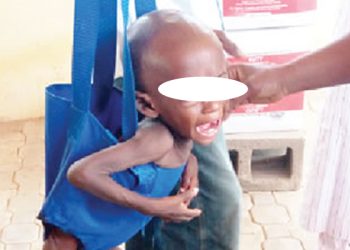 Nigeria’s child malnutrition crisis – Punch
